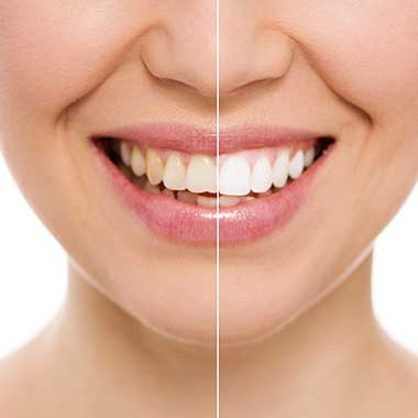 Teeth Whitening near Green Level