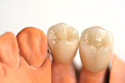 Dental Crowns Burlington