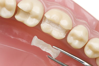 Burlington Dental Inlays