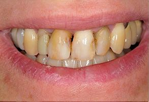 Burlington Before and After Dental Implants